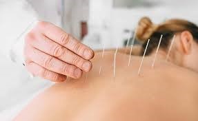 photo of an acupuncturist performing acupuncture