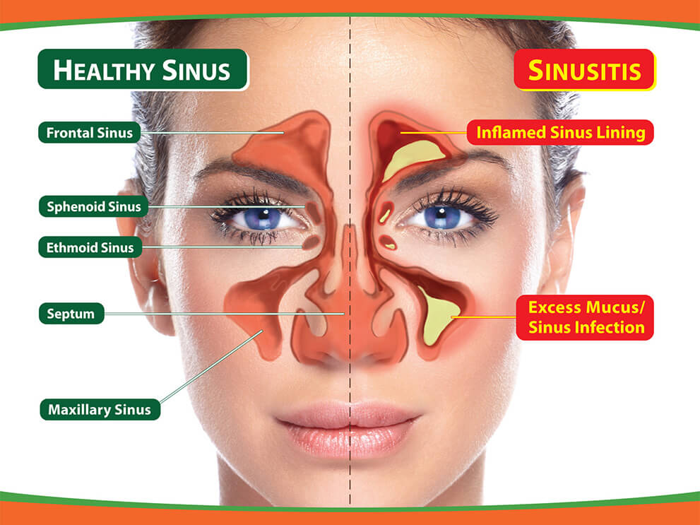 sinus treatment